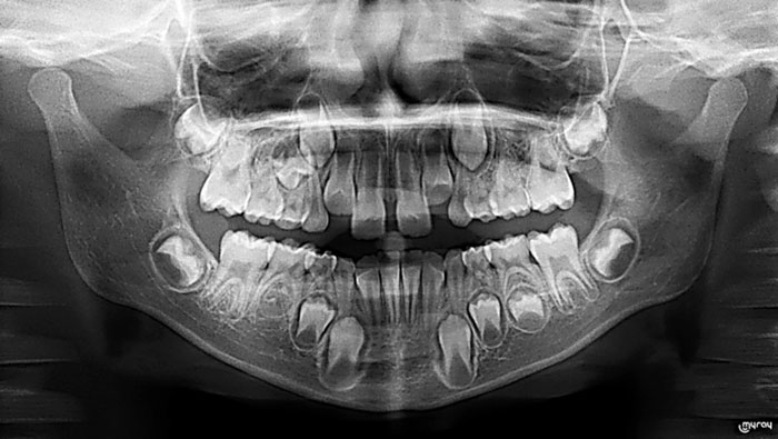 Pantomogram wykonany u dziecka w celu oceny prawidłowości wyrzynania się zębów.