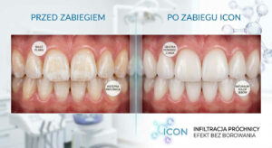 ICON - Wybielanie Warszawa